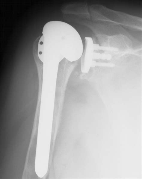 Revision Of The Humeral Component For Aseptic Loosening In Arthroplasty