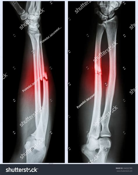 Xray Forearm Front Side Comminuted Fracture Stock Photo