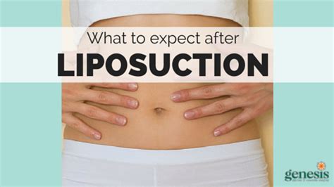 What To Expect After Liposuction Genesis Plastic Surgery And Medical Spa