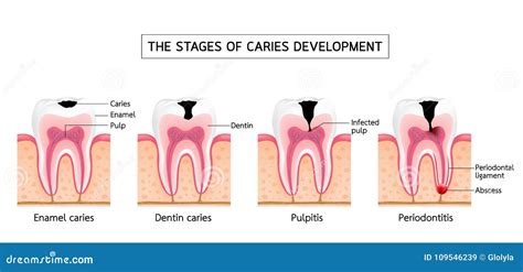 Stages Of Caries Development
