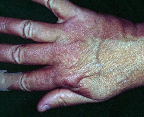 Scleromyxedema Generalized And Sclerodermoid Lichen Myxedematosus