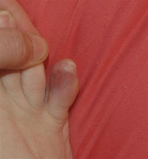 √100以上 How Do I Know If My Pinky Toe Is Broken Or Just Bruised 173823