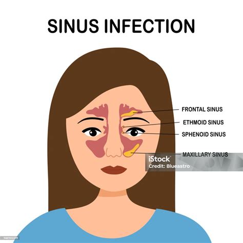 Sinusitis Or Sinus Infection Infographic In Flat Design On White