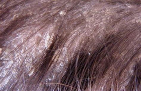 Dry Scalp Flakes Causes Treatment And Remedies Strong Hair