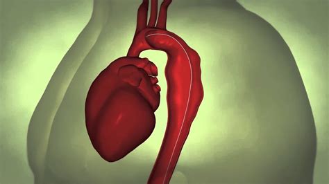 Thoracic Aortic Aneurysm Youtube