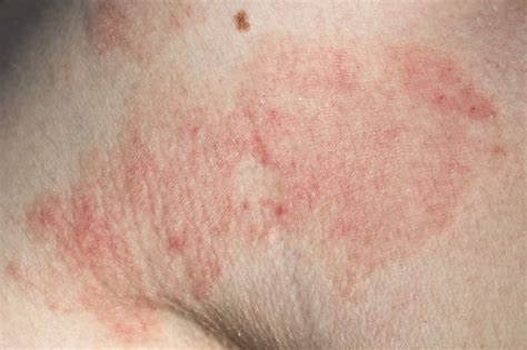 Dermatitis (also known as eczema) is inflammation of the skin, typically characterized by itchiness, redness and a rash. Ekzeme - Cosmacon