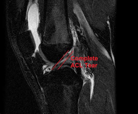 Women tear their acl more often than men. ACL Injuries - Atlanta Bone and Joint Specialists