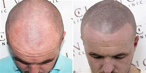 Bald Men Are Getting Head Tattoos To Hide Their Baldness