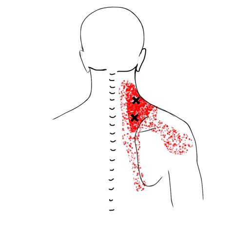 Pin On Myofascial Trigger Points 101