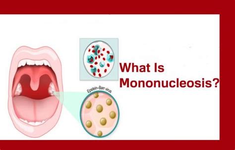 Mononucleosis Its Symptoms And Risks And Consequences