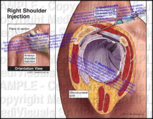 Right Shoulder Injection Subacromial Bursa Medivisuals Inc