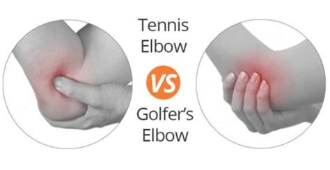 Now i'm back to normal and have the freedom from tennis/golfers elbow!! Tennis Elbow and Golfer's Elbow - What's the Difference ...