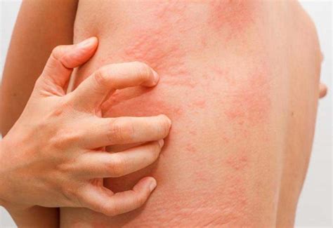 Eczéma Types Symptômes Evolution Et Complications Traitement Et