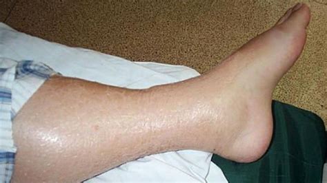 What Causes Swollen And Hot Leg New Health Advisor