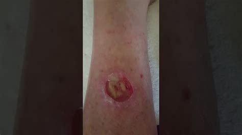 Week 2 Using Manuka Honey On Open Wound After Squamous Cell Carcinomas