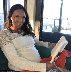 Turia Pitt Reveals How She Regained Confidence After Fire Daily Mail Online