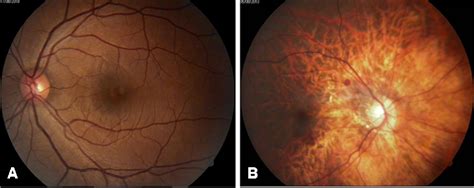 Figure 2 From Refinement Of The X Linked Nonsyndromic High Grade Myopia