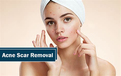 Acne Scar Removal At Houston Tx