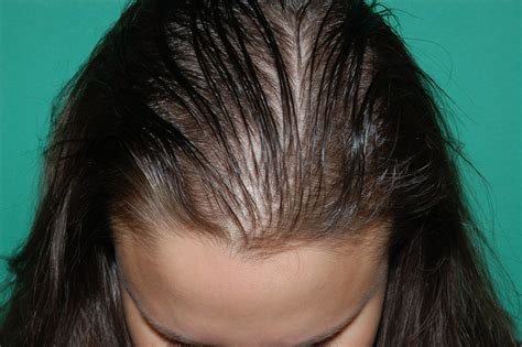 What does it mean to have balding temples? Hair Loss Treatment for Women Chicago, IL - Chicago Hair ...