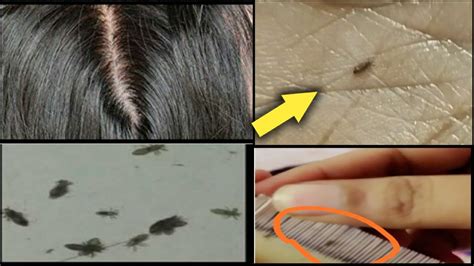 Head Lice Nit Picking Lice Nit Picking Oiled Hair Hair Oiling Lice