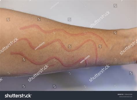 Dermatographic Urticaria Known Dermographism Dermatographism Skin写真素材