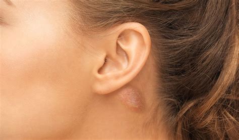 What You Need To Know About That Lump Behind Your Ear