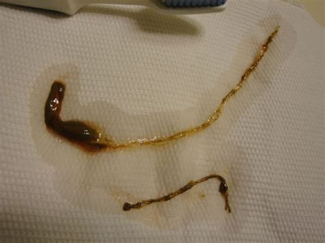 Human Stool Worm Intestinal Parasites