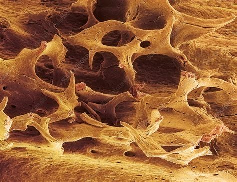 Osteoporotic Spongy Bone Sem Stock Image M2300382 Science Photo