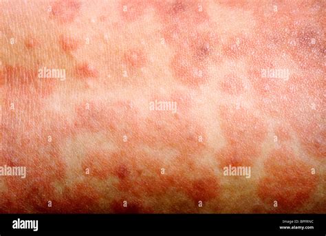 A Picture Of A Cutaneous Eruption Caused By Morbillivirus Stock Photo
