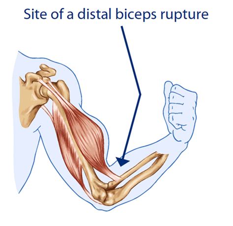 Treatment Of Distal Biceps Tendon Rupture Why When How Analysis Of My Xxx Hot Girl