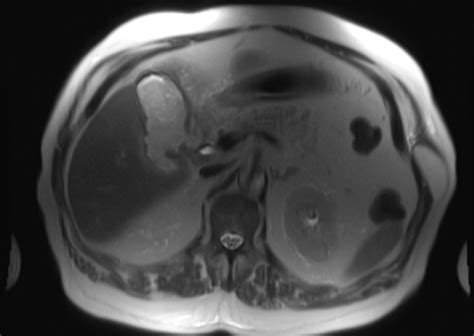 Gallbladder Perforation Image