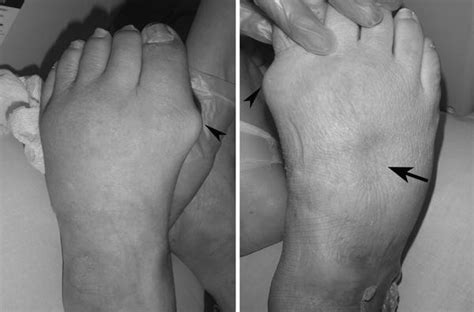 Remitting Seronegative Symmetrical Synovitis With Pitting Edema Rs3pe