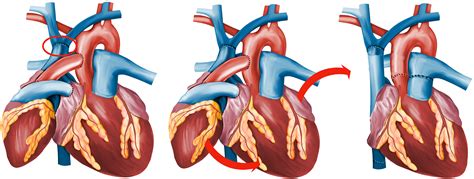 Braz J Cardiovasc Surg Heterotopic Heart Transplantation As A Left