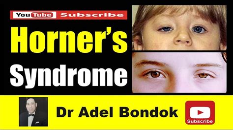 Horner S Syndrome Dr Adel Bondok Making Anatomy Easy Youtube