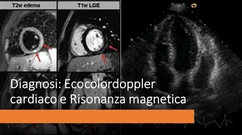 Scopri i sintomi, le cause, la diagnosi, il trattamento, i farmaci, la dieta e come controllare e prevenire la miocardite in hello sehat. Cos'è la miocardite e come si cura