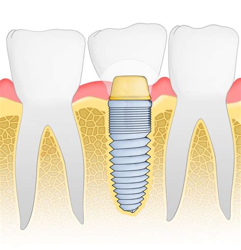 Dental Implant Placement Austin Dentistry Dr Buckingham