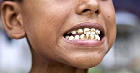 Dental Fluorosis Symptoms Causes And Treatment