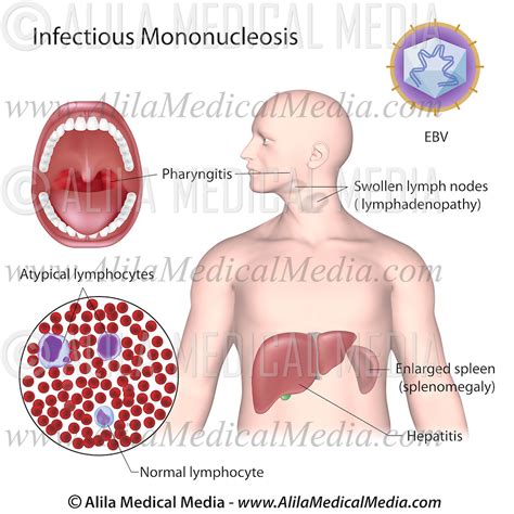 Infectious Mononucleosis Alila Medical Images