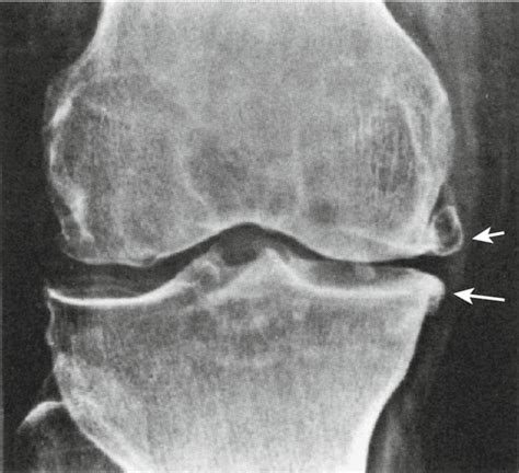 70 Knee Osteoarthritis Clinical Gate