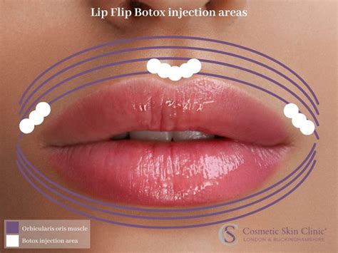 Everything You Need To Know About Lip Flip With Botox The Cosmetic Skin Clinic