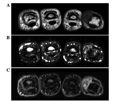 Calcifying Aponeurotic Fibroma Of The Finger In An Elderly Patient Ct