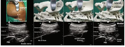 Classical snb and fnb require patient repositioning which can s. The parasacral sciatic nerve block technique. A The ...