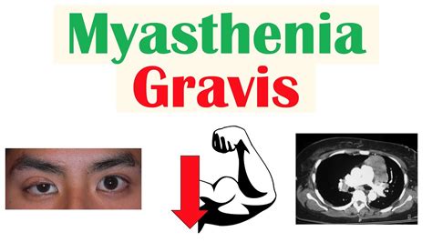 Myasthenia Gravis Pathophysiology Signs And Symptoms Diagnosis
