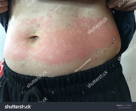 Rashes On Abdomen Caused By Hives Shutterstock