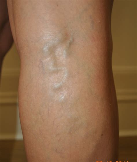 Spiderthread Veins Or Varicose Veins Whats The