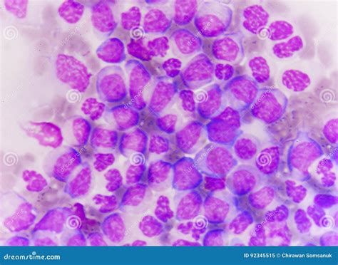 Blast Cells In Leukemia Stock Image Image Of Medicine 92345515