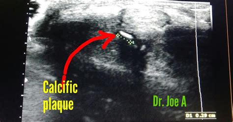 Ultrasound Imaging Penile Calcification Peyronie Disease
