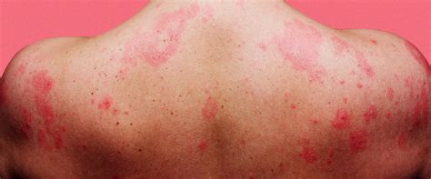 What Are Stress Hives And Rashes And How Do I Treat Them