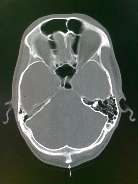 Prominent External Occipital Protuberance Radiology