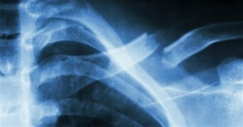 Causes Symptoms And Treatments For A Broken Collarbone Facty Health